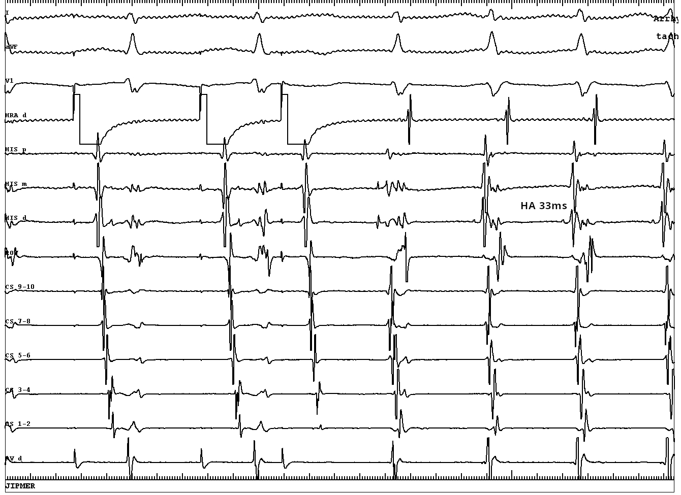 14-tachy induction with AES on iso.JPG